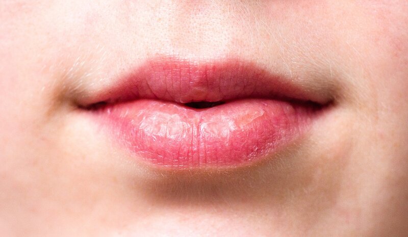 입술 포진 빨리낫는법 4가지! :: 깡주부의 꿀정보