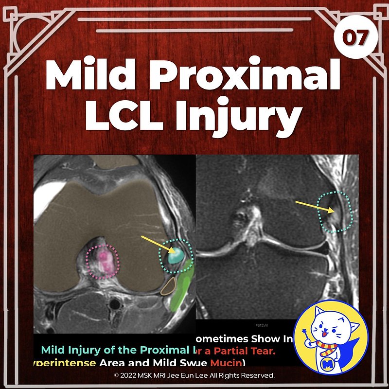 (Fig 3-B.07) Mild Proximal LCL Injury