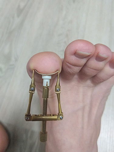 1년동안 내성발톱 교정기 사용한 자가치료 후기