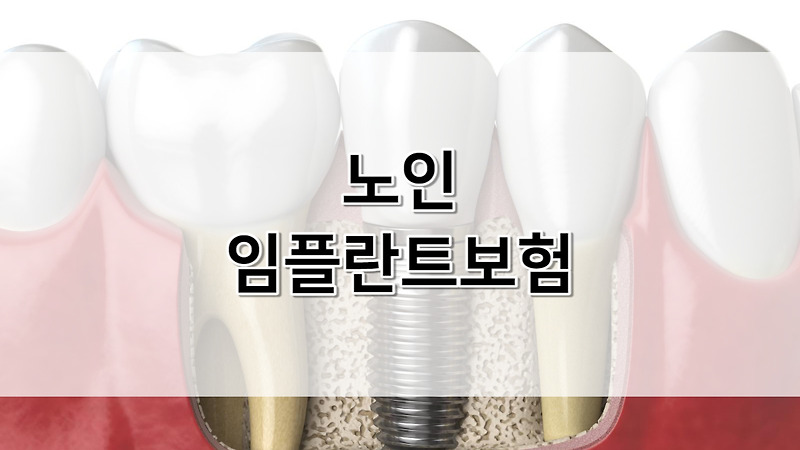 노인 임플란트보험 후기 및 혜택 | 건강보험 임플란트 적용 대상자 조회 | 65세 임플란트 틀니 지원금 대상 조건 | 신청방법 | 종류별 가격 기간