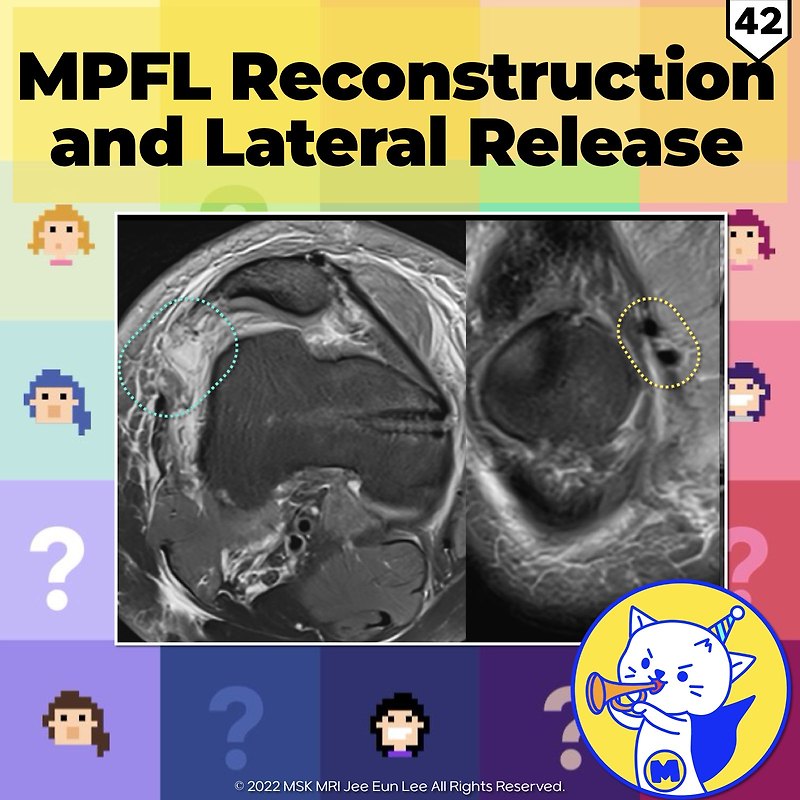 (Fig 4-A.42) MPFL Reconstruction and Lateral Release