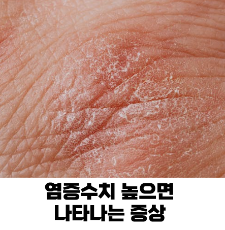 염증수치가 높으면 나타나는 증상 5가지 필수 확인!