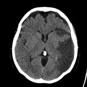 중환자에서 발생하는 stroke, focal neurologic deficit, seizures, generalized ...