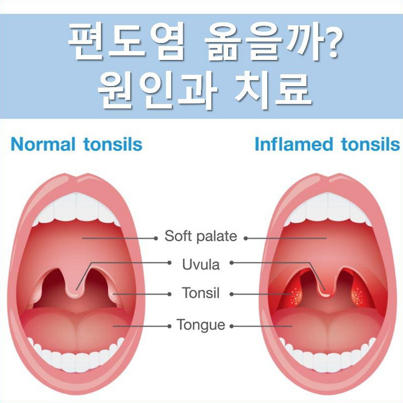 편도염 옮나요? │원인과 증상, 치료법