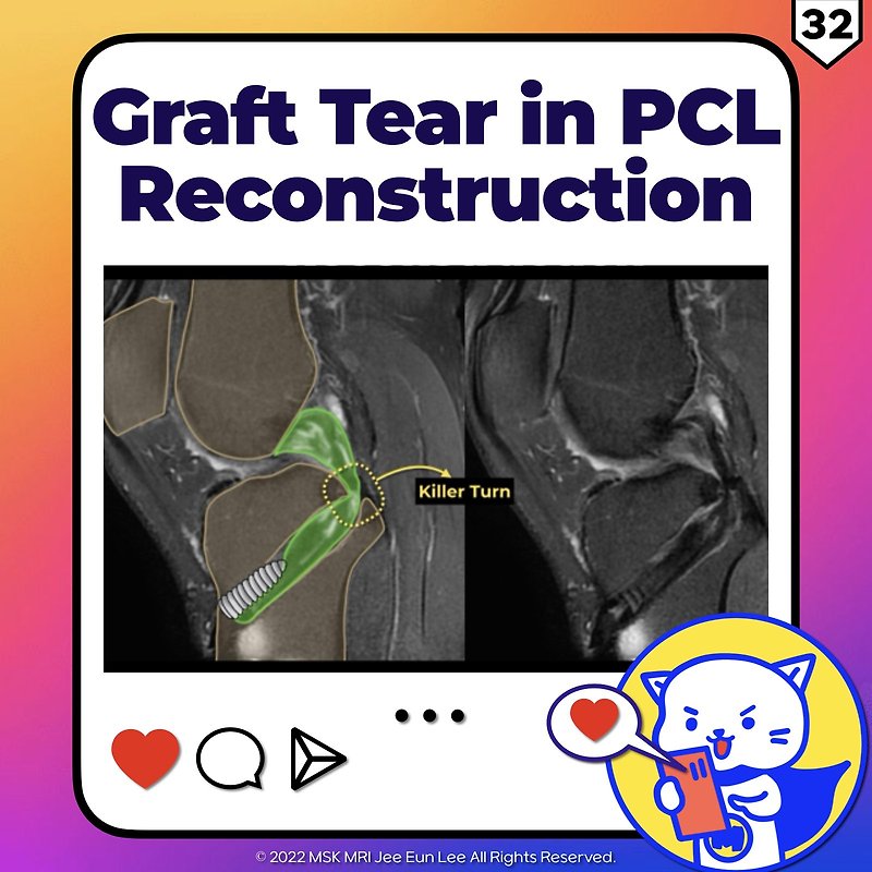 (fig 2-e.32) Graft Tear In Pcl Reconstruction: Killer Turn Of The 