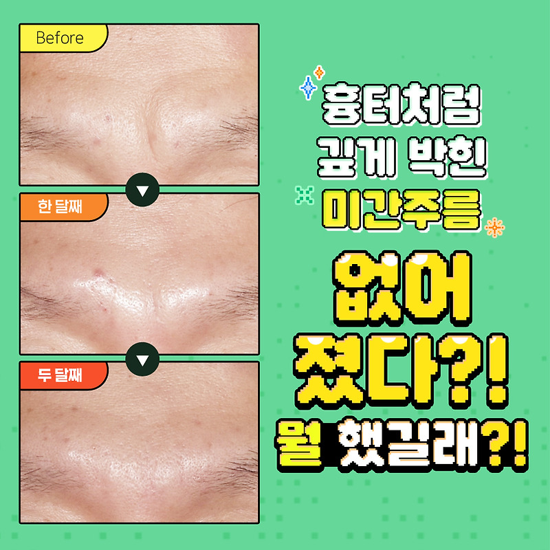 흉터처럼 깊게 박힌 미간주름, 분당미간주름시술 자가진피재생술로 해결하기!