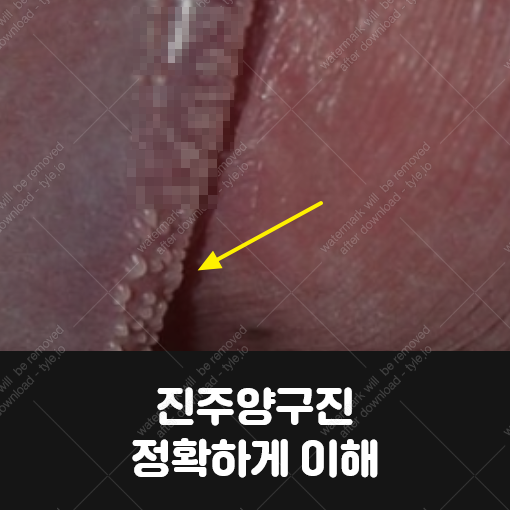 진주양구진 정확하게 알고 대처