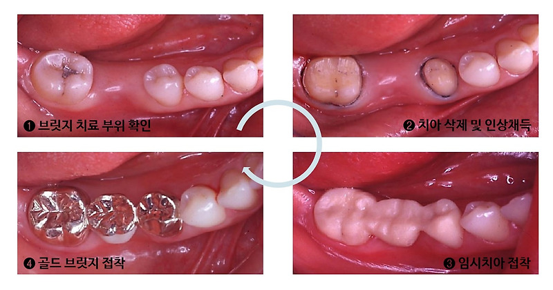 치아 브릿지 장단점 / 브릿지치료과정 / 어금니 브릿지/ 앞니 브릿지