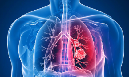 폐암 (Lung cancer) 발병시 초기증상과 대처법