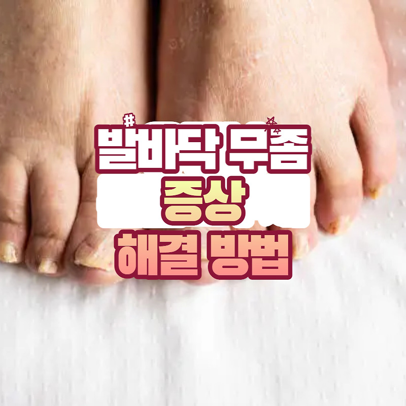 발바닥 무좀 증상 및 해결 방법