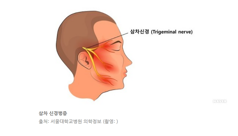 대구 삼차신경통 눈이 감기고 입이 움직이고 있습니다.