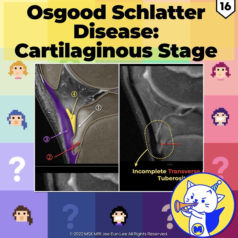 (Fig 4-B.16) Osgood Schlatter Disease: Cartilaginous Stage