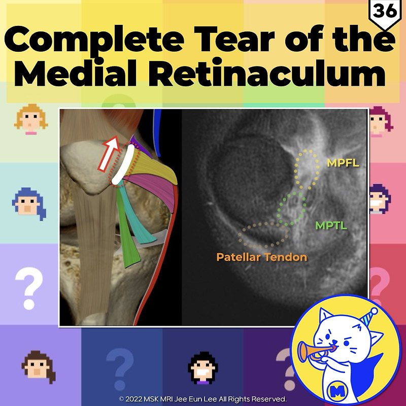 (fig 4-a.36) Complete Tear Of The Medial Retinaculum