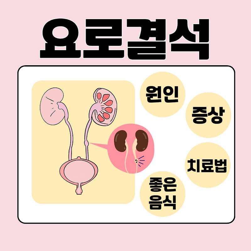 요로결석 원인 / 증상 / 치료법 / 좋은음식