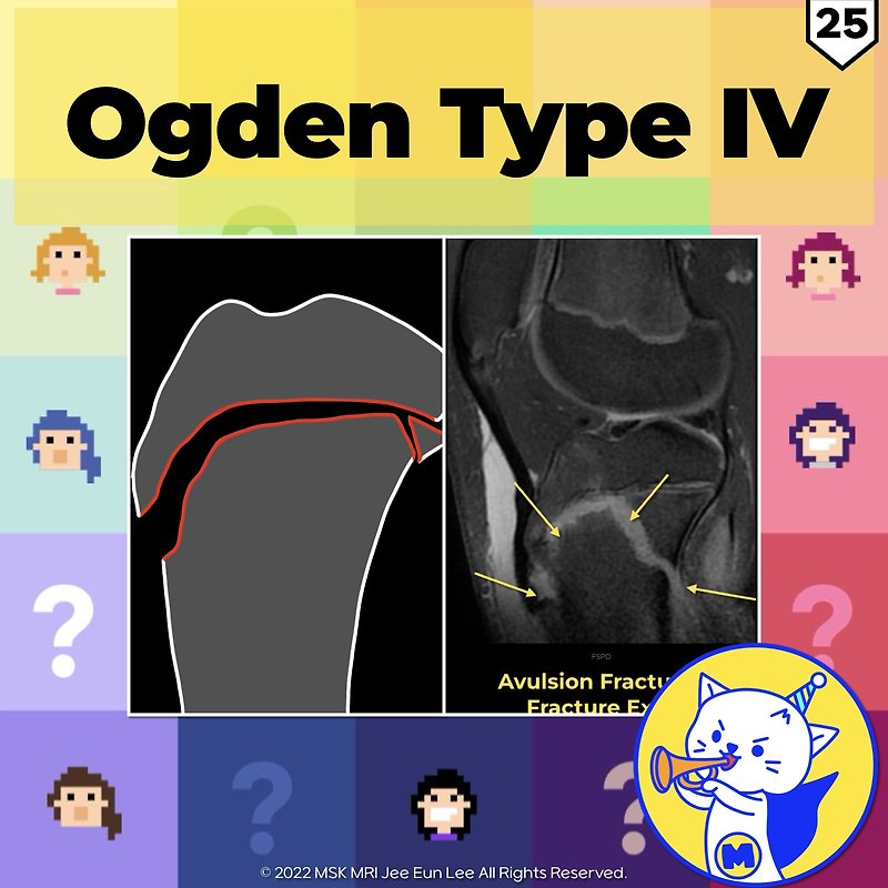 (Fig 4-B.25) Ogden Type IV Tibial Tuberosity Fracture