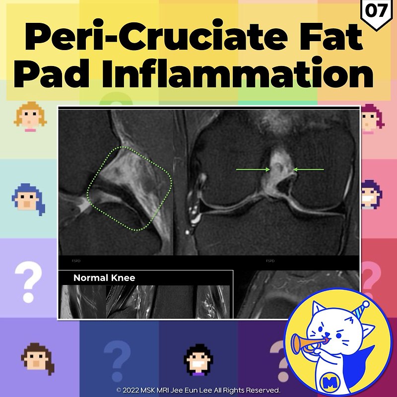 (Fig 4-C.07) Peri-cruciate Fat Pad Inflammation