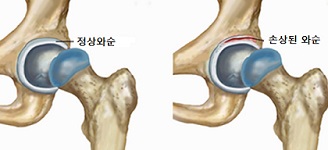 여자 사타구니 통증 10가지 원인과 대응