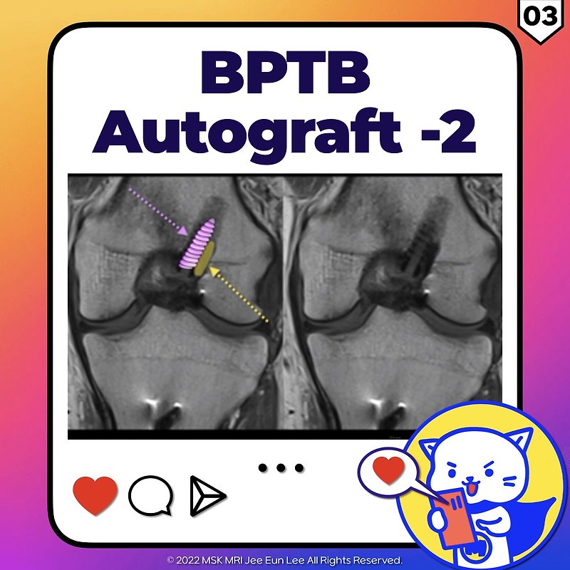 (Fig 2-C.02) Bone-patellar tendon-bone (BPTB) autograft -2