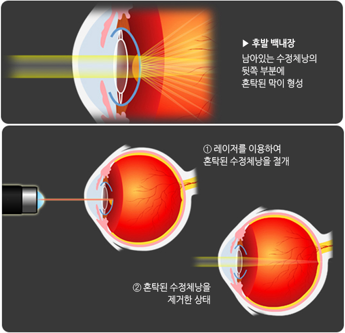 [질병후기] 후발성백내장 수술후기