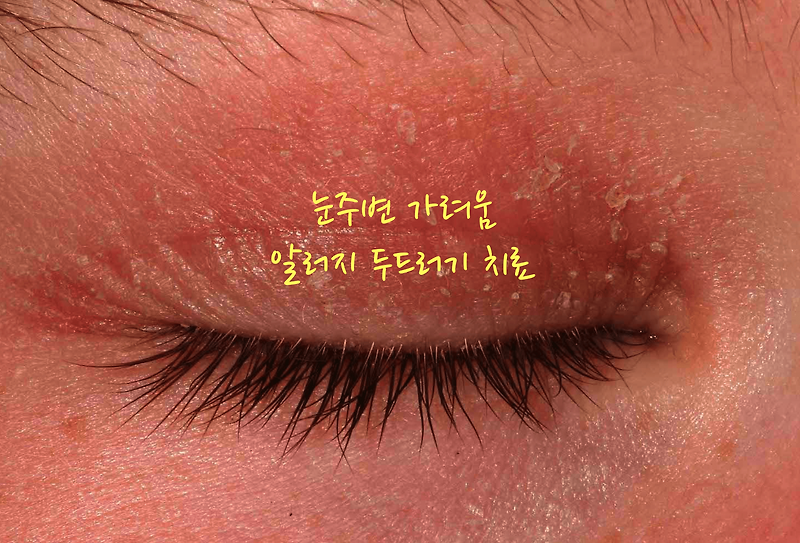 눈주변 가려움 알러지 두드러기 치료