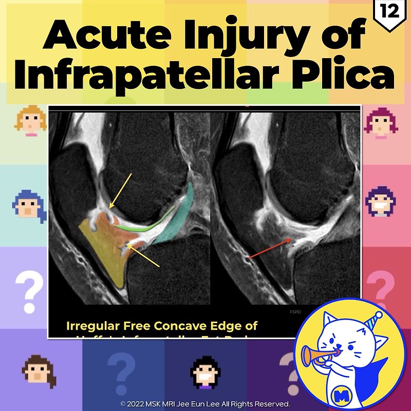 (fig 4-c.12) Acute Injury Of Infrapatellar Plica