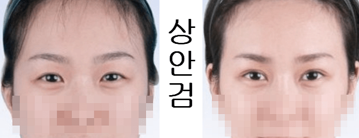 눈처짐 수술비용 생각보단 (상안검 수술 vs 눈썹하거상술)