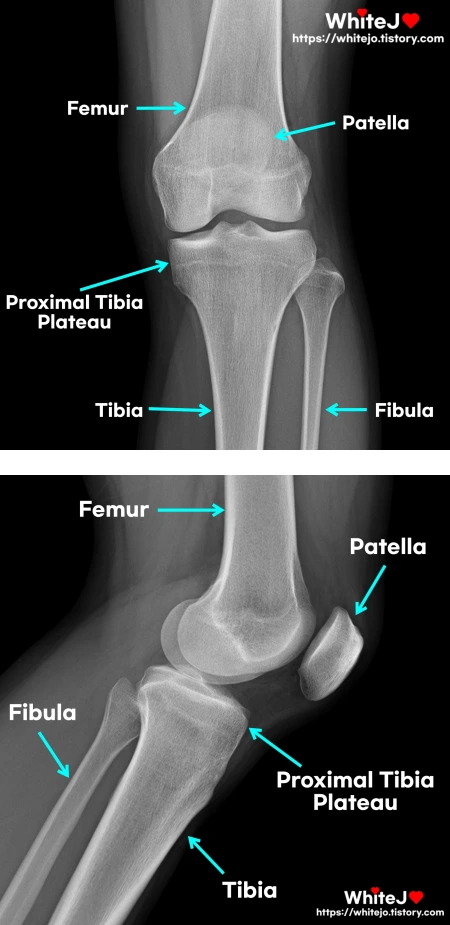 죠뉴벨 의학용어 - 무릎 주위 뼈 femur , patella, tibia, fibula, proximal tibia plateau