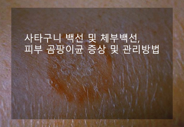 사타구니 백선 및 체부백선, 피부 곰팡이균 증상 및 관리방법 :: everything~