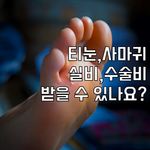 티눈, 사마귀 실비,수술비 받을 수 있나요?