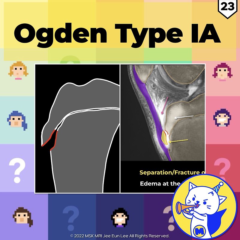 (Fig 4-B.23) Ogden Type IA Tibial Tuberosity Fracture