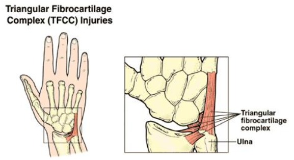 삼각섬유연골 복합체(TFCC) 손상 : 원인, 증상, 치료