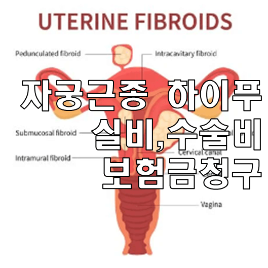 하이프 시술 실비가 가능한 이유