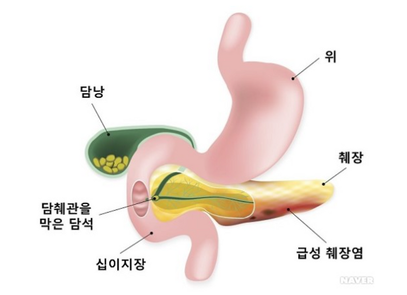 급성췌장염증상과 원인