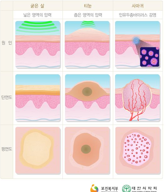 티눈 생기는 원인과 뽑기 셀프 제거 방법 치료 법