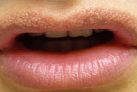 입술 포다이스반 원인 증상, 치료방법
