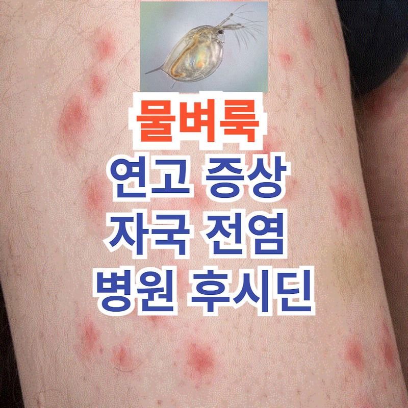 물벼룩 후시딘 병원 물림 자국 전염 연고 증상 동해 바다