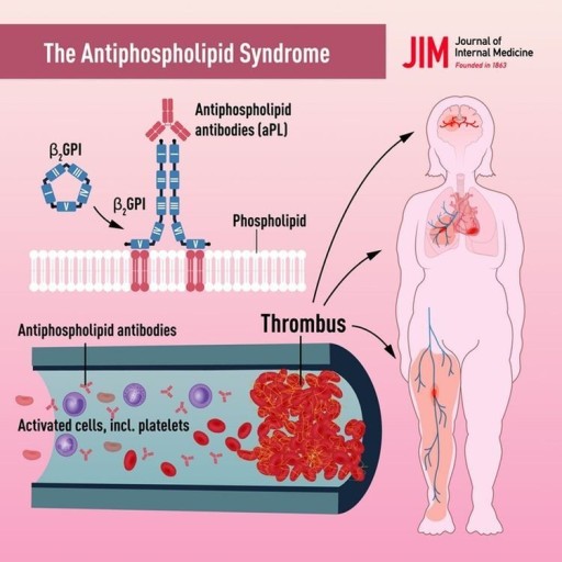 항인지질항체증후군 Aps 혈액응고를 유발하는 자가면역질환