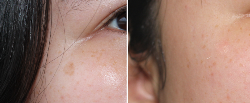 검버섯 레이저 가격을 고려할 때 고려해야 할 내용이 궁금하다면요?