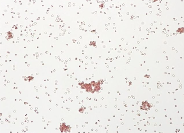 혼합시야반응이란 (Mixed filed agglutination) 정의, 원인, 검사법