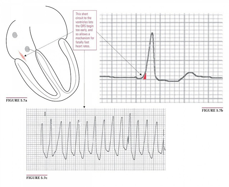 wolff-parkinson-white-syndrome