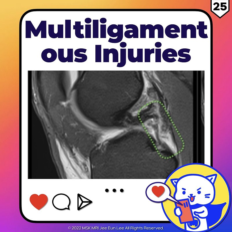 (fig 2-e.25) Multiligamentous Injuries Associated With Pcl Injuries