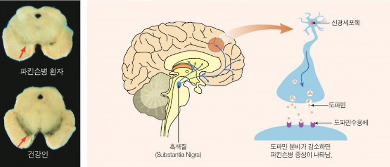파킨슨병 증상