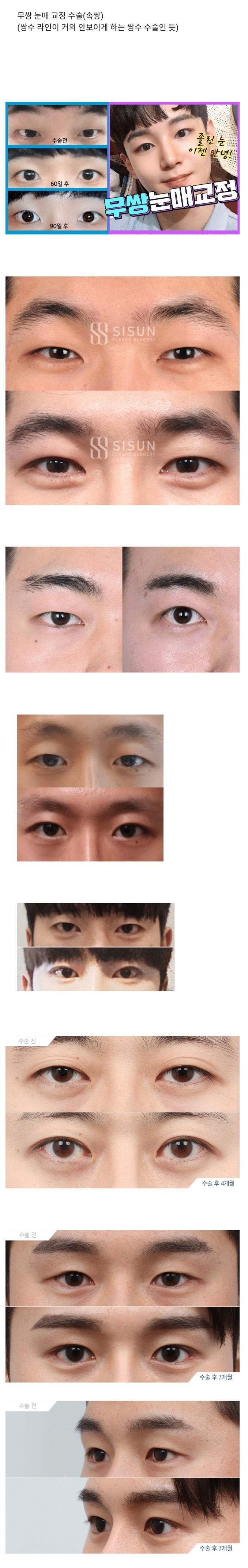 남자들 사이에서 유행이라는 성형 - 꾸르