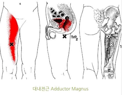 내몸통증 근육케어