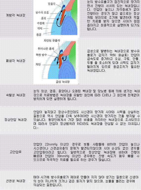 녹내장종류 알고 해결방안찾자