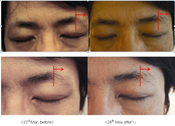 Interim Report Of Eyebrow Restorer Clinical Trial