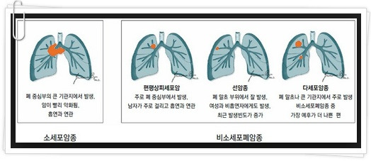 폐암 초기증상 폐암 증상의 원인과 검사 및 항암치료