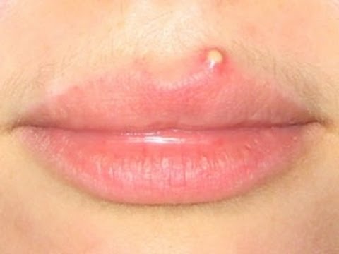 입 주위 여드름 원인 및 예방법 - 하루라도 빨리 낫는 방법
