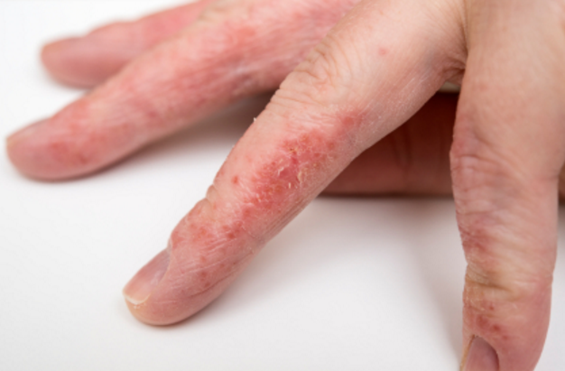 손습진 치료법 피부 가려움증 원인 및 없애는법