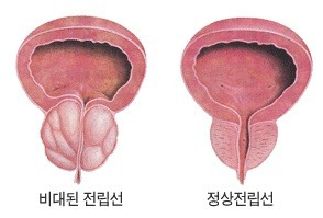 소변 후 잔뇨를 느끼면 4